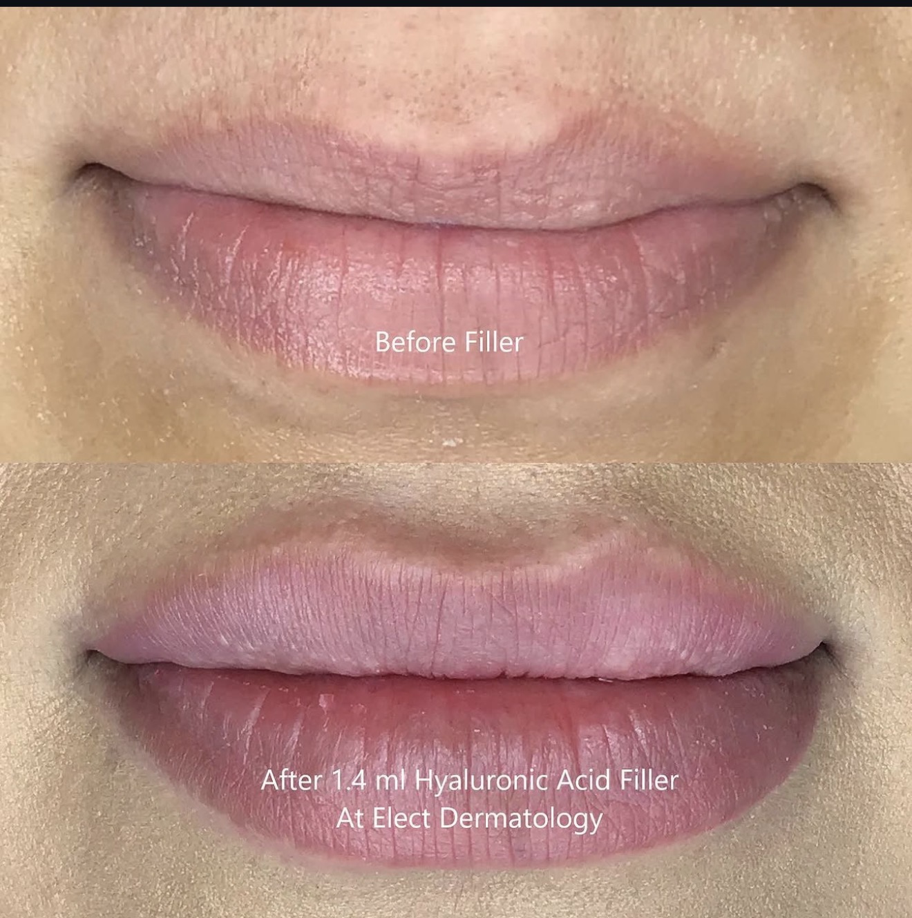 Everything You Need to Know About Dermal Fillers in New Braunfels, TX