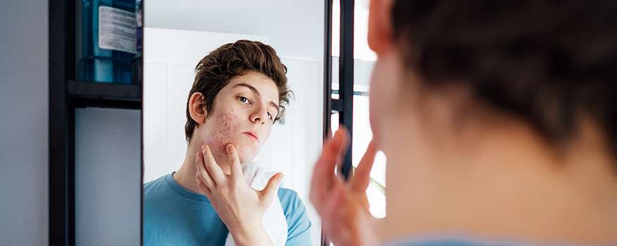 Acne at Any Age: Treatment Options for Teens and Adults