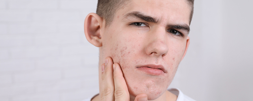 Acne Treatment in New Braunfels: Effective Solutions for Clearer, Healthier Skin