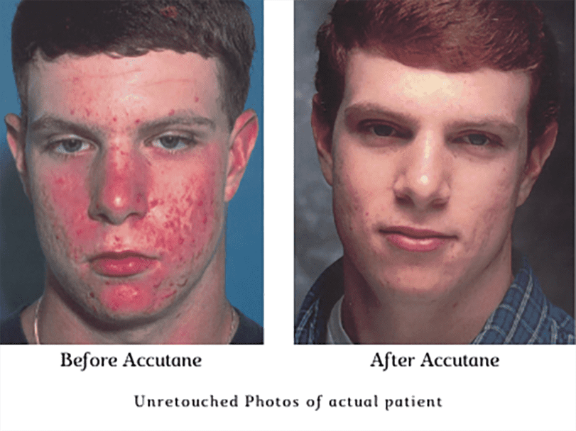 Acne Scars Before And After Accutane