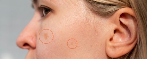 What Causes Dark Spots on the Face?