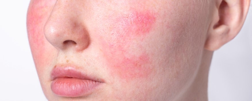 Rosacea: Causes, Triggers, and Treatment Options