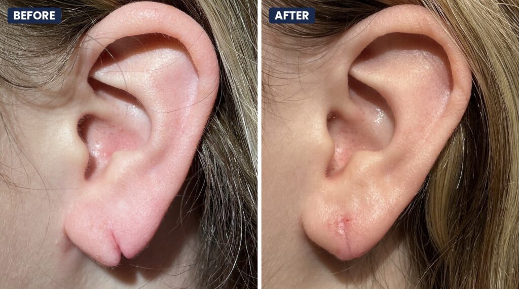 Before and after earlobe repair in New Braunfels, TX: a completely split earlobe and the same earlobe after surgical repair at Elect Dermatology