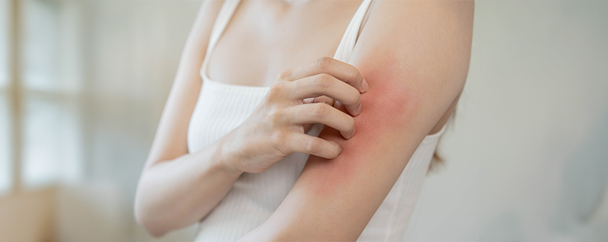Eczema: Treatment and Prevention Tips for Healthier Skin