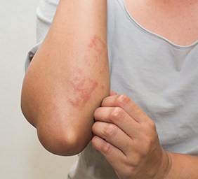 Eczema Treatment New Braunfels, TX