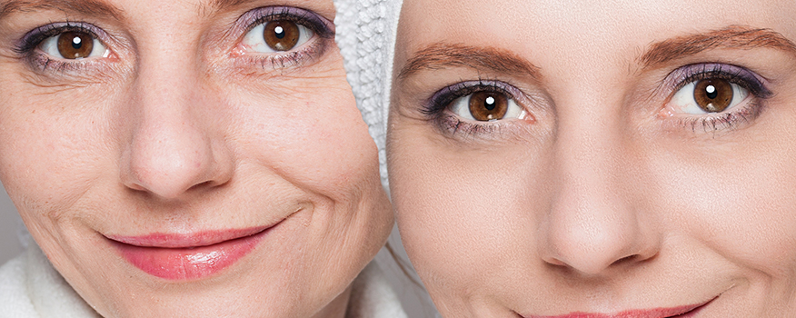 Facial Rejuvenation: Microneedling and Chemical Peels