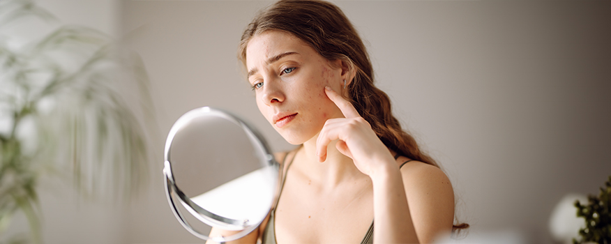 Main Causes of Acne and When to See a Dermatologist for Treatment
