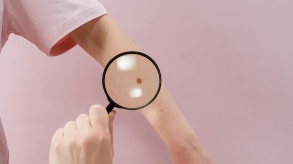 Magnifying glass examining skin mole during skin cancer screening in New Braunfels