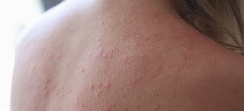 Skin Disease of the Week: Polymorphic Light Eruption | Elect Dermatology