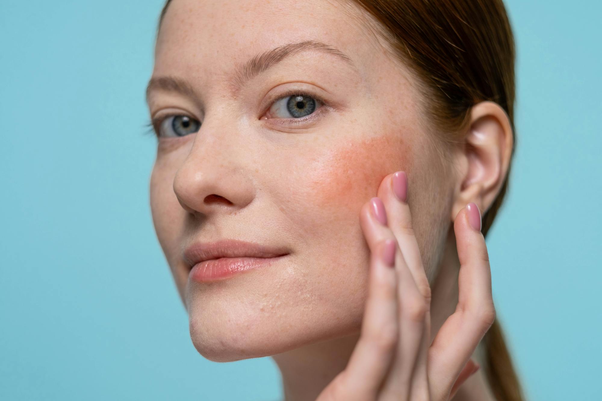 Rosacea Treatment in New Braunfels: What Actually Works and When to See a Dermatologist
