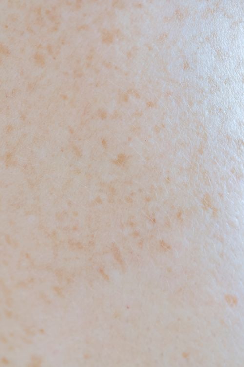 Melasma Treatment in New Braunfels: What Actually Works