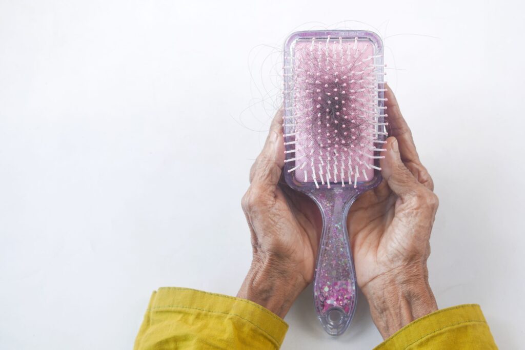 Person holding hairbrush showing hair loss — alopecia areata treatment at Elect Dermatology New Braunfels TX