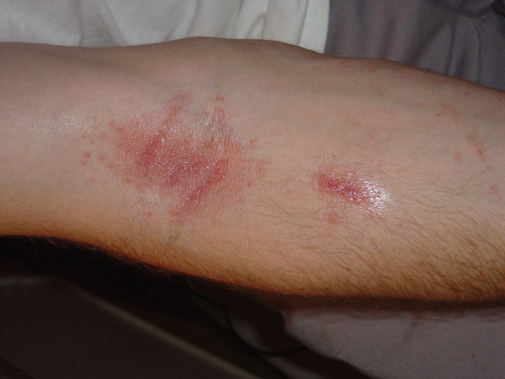 Contact Dermatitis: Identifying and Treating Allergic Rashes in New Braunfels, TX