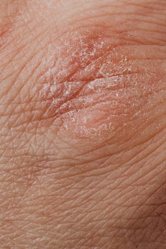 Psoriasis Treatment in New Braunfels: What a Dermatologist Can Do That Over-the-Counter Products Can’t