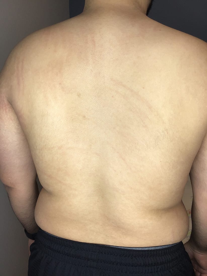 Rash Treatment Results New Braunfels, TX