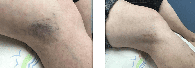 Sclerotherapy Vein Treatment New Braunfels, TX