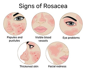 Signs of Rosacea New Braunfels, TX