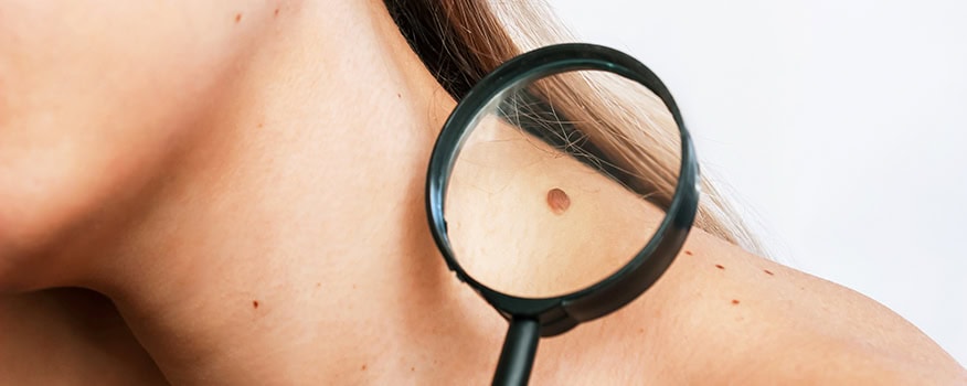 Dermatology 101: 5 Signs That a Mole Might Be Cancerous