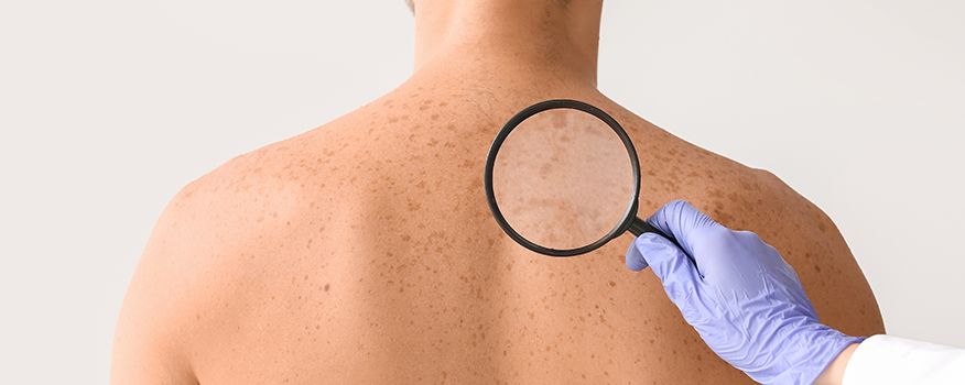 Skin Cancer Awareness: Early Detection and Prevention Tips