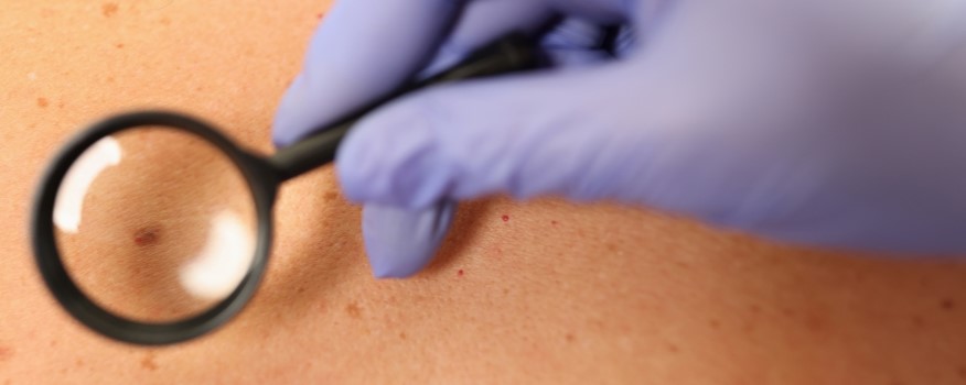 Skin Cancer: Prevention, Detection, and Treatment