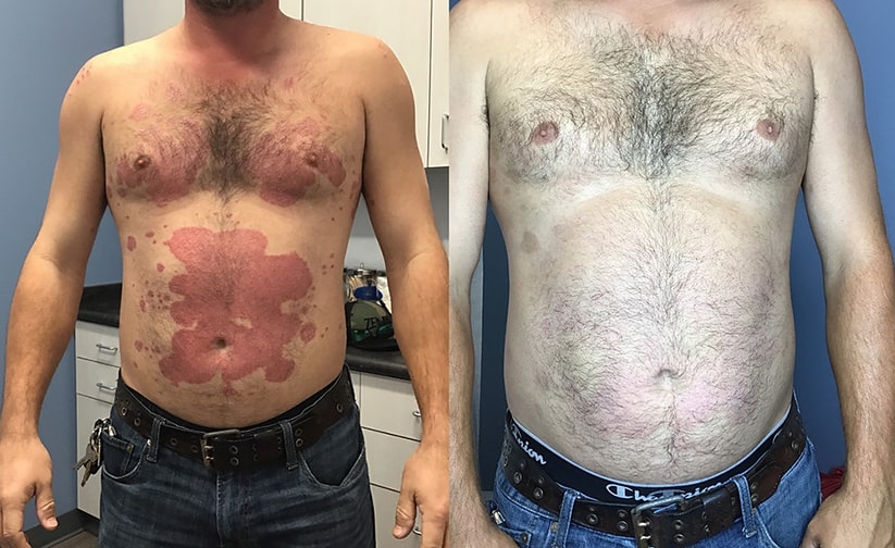 Treating Psoriasis New Braunfels, TX
