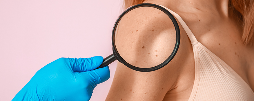 How to Know When a Spot on Your Skin Needs to Be Checked by a Dermatologist