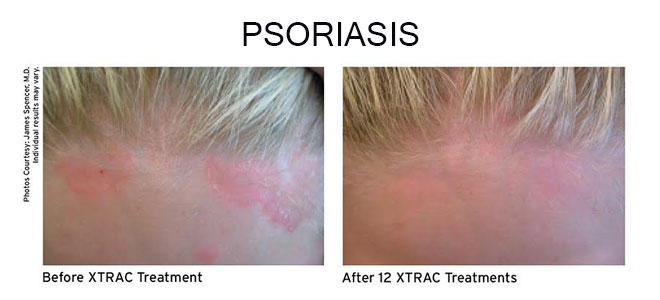 XTRAC laser treatment for eczema and Psoriasis in New Braunfels TX reducing inflammation and skin irritation