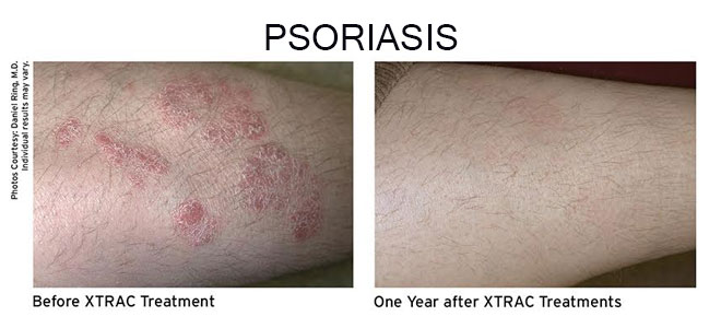 XTRAC laser treatment for psoriasis in New Braunfels TX targeting plaques and inflamed skin