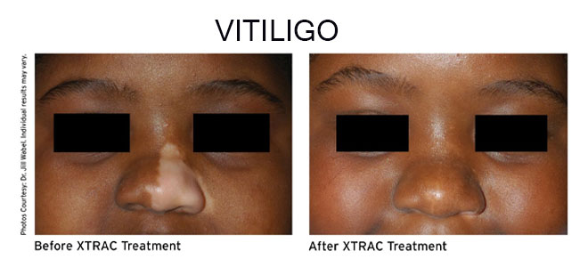XTRAC laser treatment for vitiligo in New Braunfels TX helping restore skin pigmentation