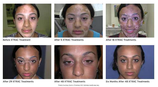 before and after XTRAC laser treatment for vitiligo in New Braunfels TX showing improved pigmentation